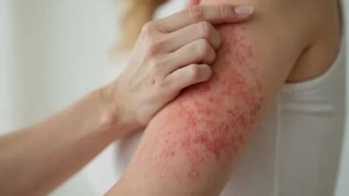 Photo of जिसे साधारण एलर्जी समझ रहे हैं, कहीं वो अर्बन आई सिंड्रोम तो नहीं?